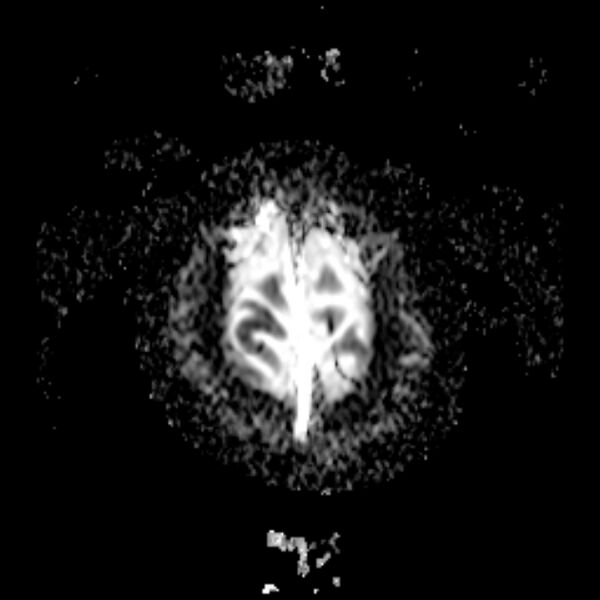 File:Cerebral tuberculoma (Radiopaedia 41152-43932 Axial ADC 23).jpg