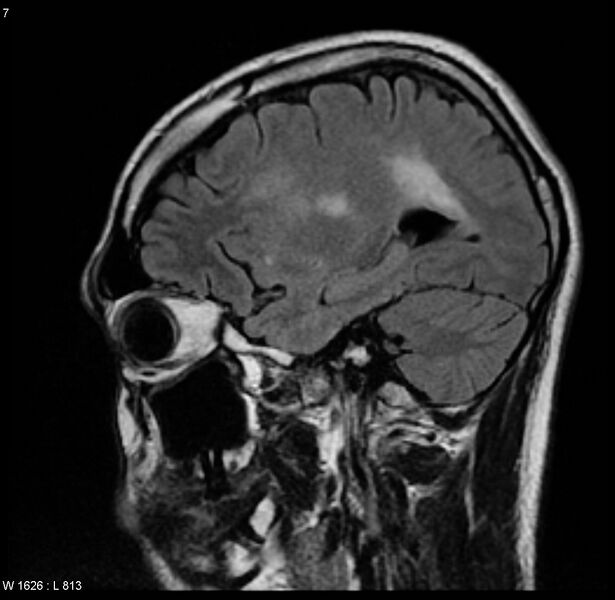 File:Cerebral vasculitis (Radiopaedia 5131-6923 Sagittal FLAIR 1).jpg