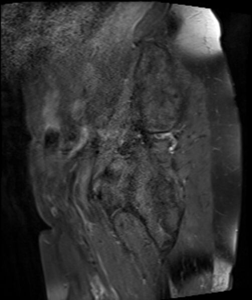 File:Cervical carcinoma (Radiopaedia 88312-104943 E 5).jpg
