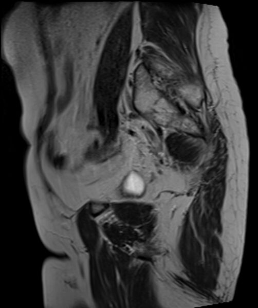 File:Cervical carcinoma (Radiopaedia 88312-104943 Sagittal T2 9).jpg