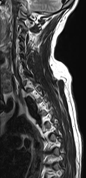 File:Cervical compressive myelopathy (Radiopaedia 71956-82411 Sagittal T2 11).jpg