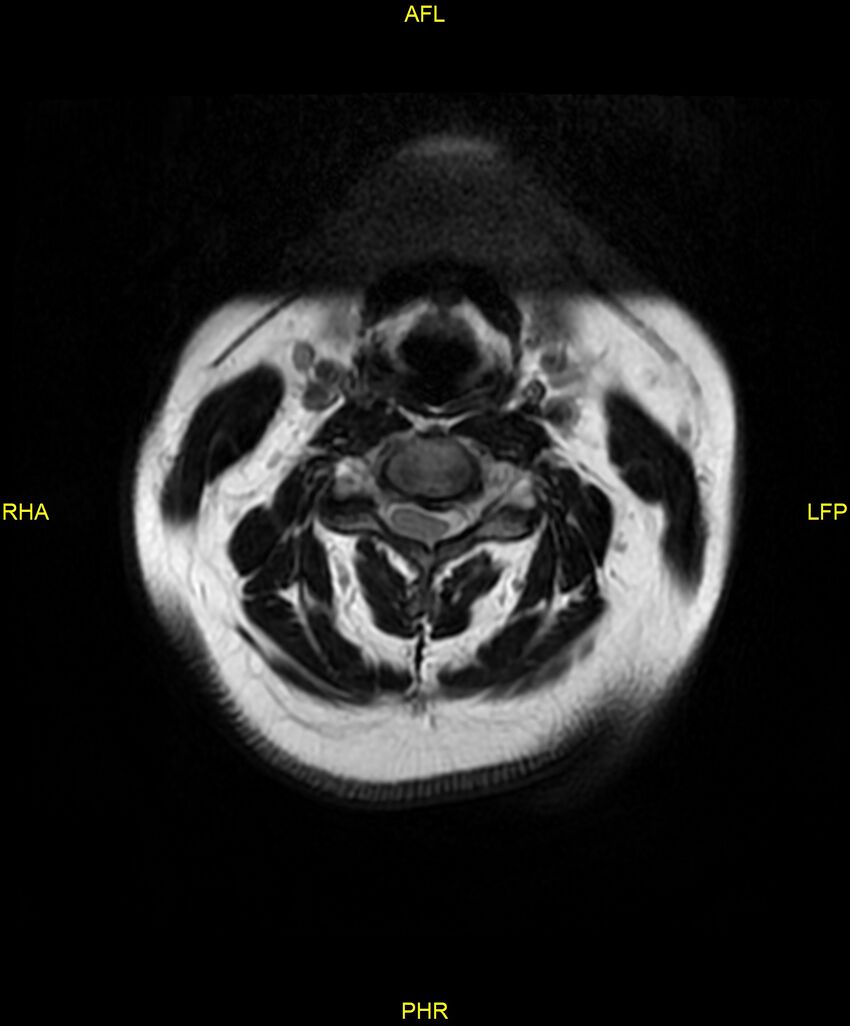 Cervical disc protrusion (Radiopaedia 87147-103415 Axial T2 5).jpg