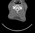 Cervical dural CSF leak on MRI and CT treated by blood patch (Radiopaedia 49748-54996 B 31).png