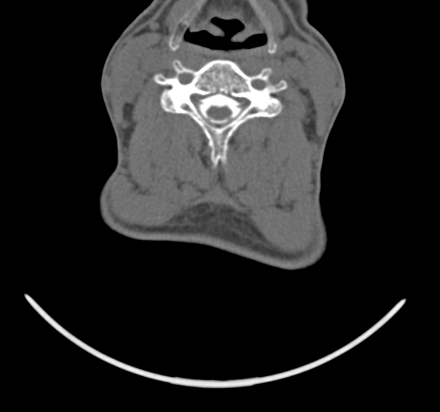 File:Cervical dural CSF leak on MRI and CT treated by blood patch (Radiopaedia 49748-54996 B 31).png