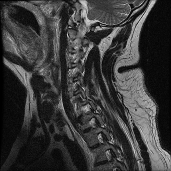 File:Cervical fracture and dislocation with locked facet (Radiopaedia 31837-32781 Sagittal T2 12).jpg