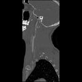 Cervical spine fractures with vertebral artery dissection (Radiopaedia 32135-33078 Sagittal bone window 38).jpg
