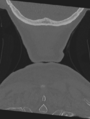 Cervical spondylolysis (Radiopaedia 49616-54811 Coronal bone window 64).png