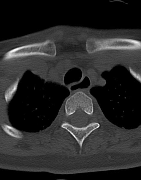 File:Cervical tuberculous spondylitis (Radiopaedia 39149-41365 Axial bone window 52).png