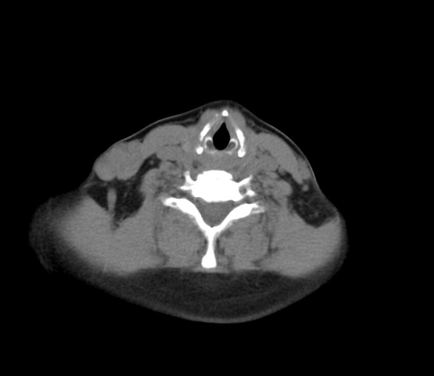 Cervical venous malformation (Radiopaedia 22653-22672 Axial non-contrast 39).jpg