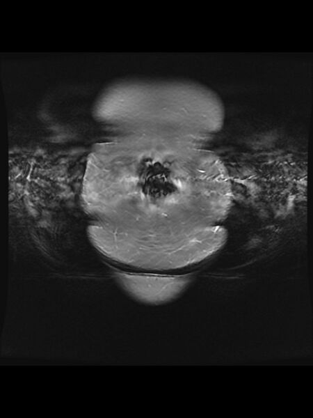 File:Cesarean section scar endometrioma (Radiopaedia 56569-63297 Coronal STIR 3).jpg