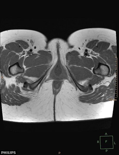File:Cesarian scar endometriosis (Radiopaedia 68495-78066 Axial T1 28).jpg