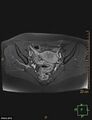 Cesarian scar endometriosis (Radiopaedia 68495-78066 Axial T1 C+ fat sat 11).jpg