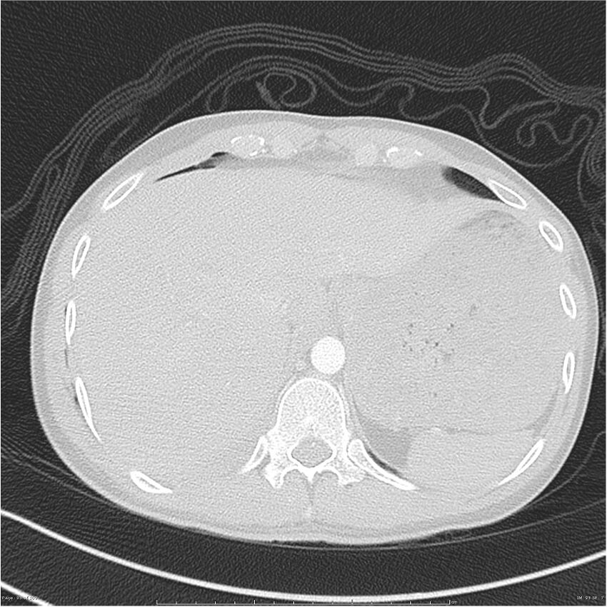 Chest and abdomen multi-trauma (Radiopaedia 26294-26425 lung window 93).jpg