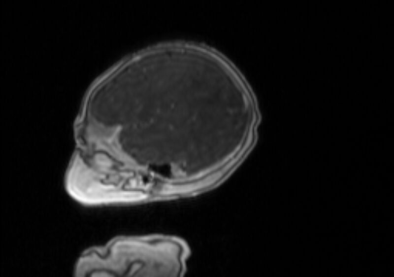 File:Chiari III malformation with occipital encephalocele (Radiopaedia 79446-92559 Sagittal T1 C+ mpr 54).jpg