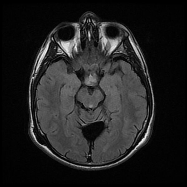 File:Chiasmatic-hypothalamic juvenile pilocytic astrocytoma (Radiopaedia 78533-91235 Axial FLAIR 12).jpg