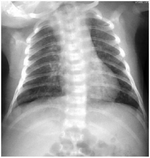Chlamydia neonate pneumonia chest X-ray.png