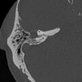 Cholesteatoma (Radiopaedia 15846-15494 bone window 6).jpg