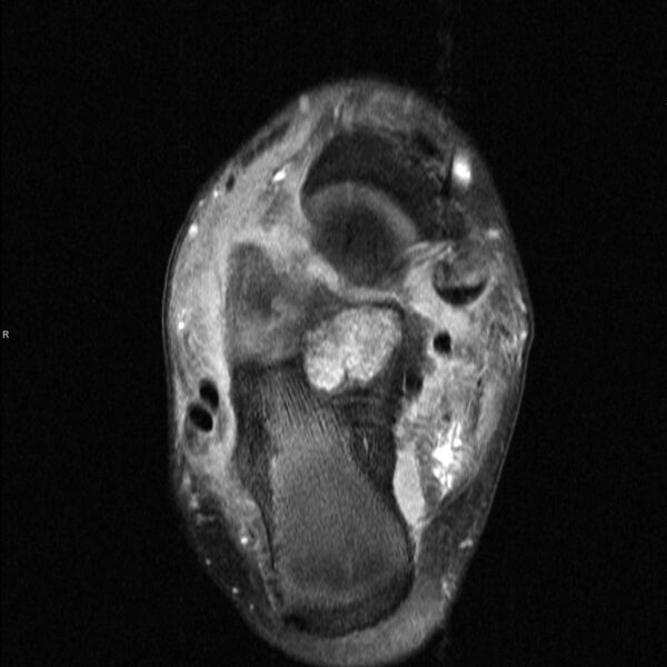 File:Chondroblastoma- calcaneum (Radiopaedia 10337-10859 Axial T2 fat sat 2).jpg