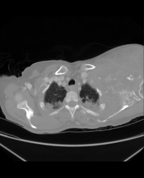 File:Chondrosarcoma (Radiopaedia 79427-92535 Axial lung window 7).jpg