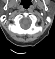 Chordoma (C4 vertebra) (Radiopaedia 47561-52188 Axial non-contrast 5).png