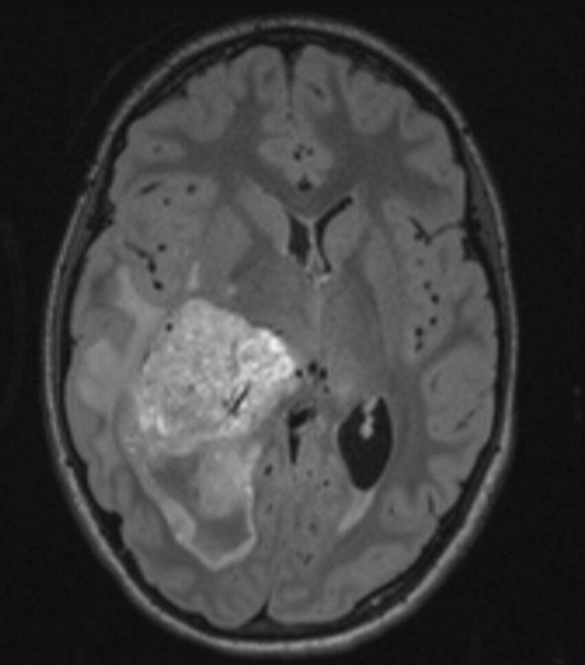 Choroid plexus carcinoma (Radiopaedia 91013-108553 Axial FLAIR C+ 133).jpg