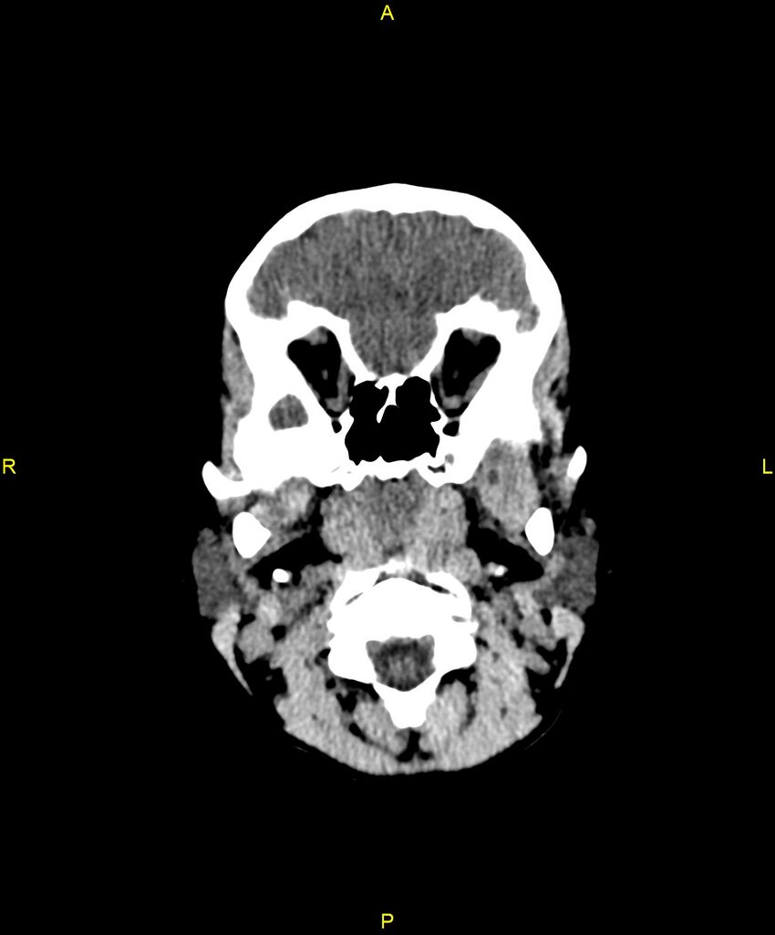 Choroidal fissure cyst (Radiopaedia 89481-106465 Axial non-contrast 18).jpg