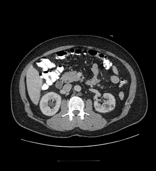 File:Chromophobe renal cell carcinoma (Radiopaedia 84337-99644 C 53).jpg