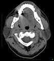 Chronic Submandibular sialolithiasis (Radiopaedia 16880-16606 Axial non-contrast 9).jpg