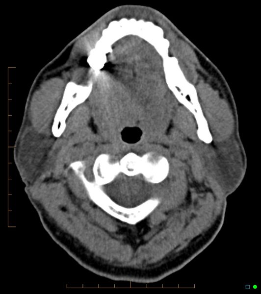 File:Chronic Submandibular sialolithiasis (Radiopaedia 16880-16606 Axial non-contrast 9).jpg