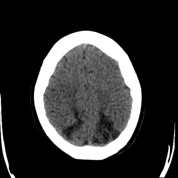 File:Chronic bilateral occipital lobe infarcts (Radiopaedia 31276-31996 Axial non-contrast 33).jpg