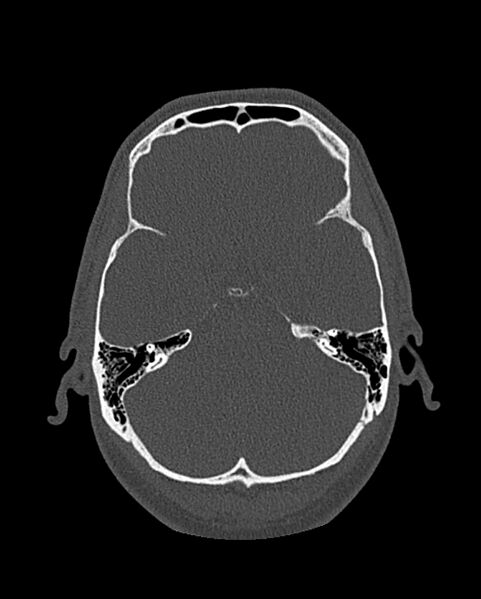 File:Chronic maxillary sinusitis caused by a foreign body (Radiopaedia 58521-65676 Axial bone window 277).jpg