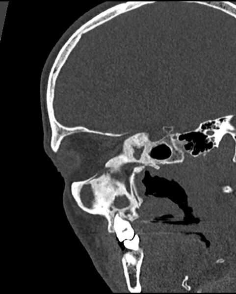 File:Chronic maxillary sinusitis caused by a foreign body (Radiopaedia 58521-65676 Sagittal bone window 44).jpg