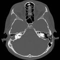Chronic otomastoiditis (Radiopaedia 27138-27309 Axial bone window 40).jpg