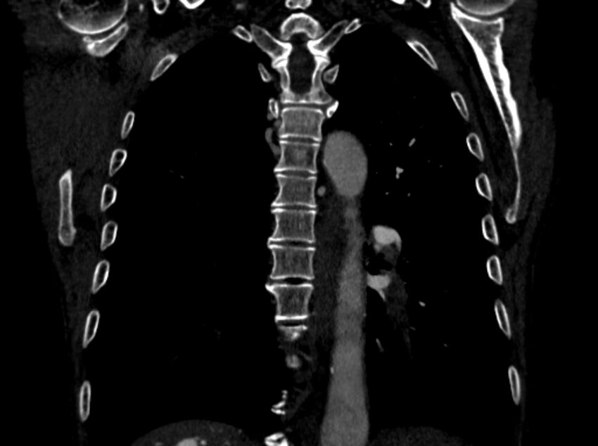 Chronic pulmonary embolism (Radiopaedia 91241-108843 A 76).jpg