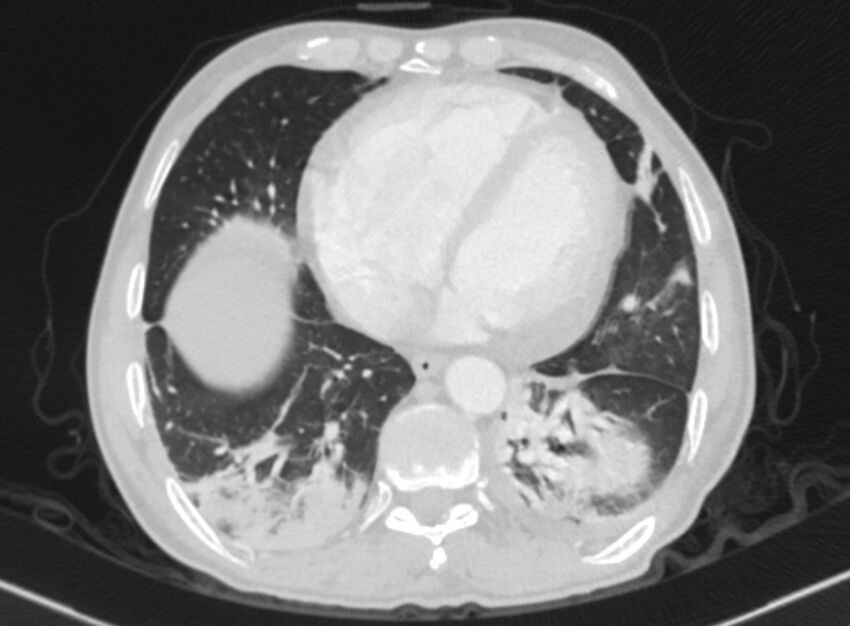 Chronic pulmonary embolism with bubbly consolidation (Radiopaedia 91248-108850 Axial lung window 115).jpg