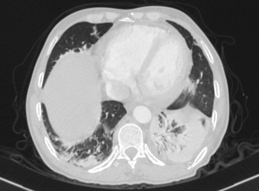 Chronic pulmonary embolism with bubbly consolidation (Radiopaedia 91248-108850 Axial lung window 121).jpg