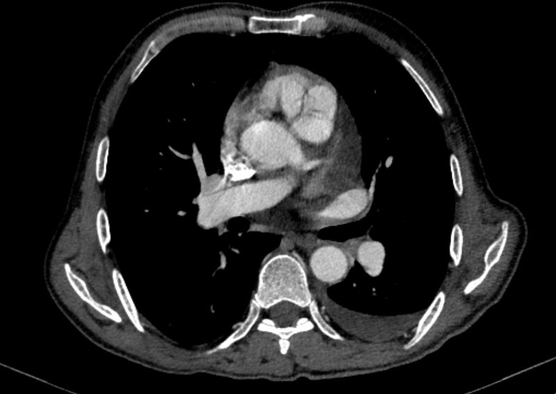 File:Chronic pulmonary embolism with bubbly consolidation (Radiopaedia 91248-108850 C+ arterial phase 76).jpg