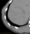 Chronic subcapsular hepatic hematoma (Radiopaedia 29548-30051 G 1).jpg