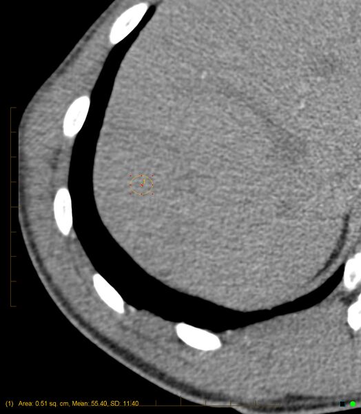 File:Chronic subcapsular hepatic hematoma (Radiopaedia 29548-30051 G 1).jpg