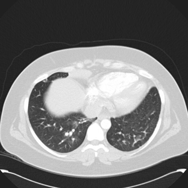 File:Chronic thromboembolic pulmonary hypertension (CTEPH) (Radiopaedia 74597-85531 Axial lung window 38).jpg