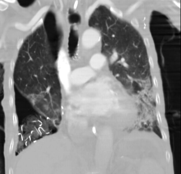 File:Clagett thoracotomy with bronchopleural fistula (Radiopaedia 29192-29587 Coronal lung window 17).jpg