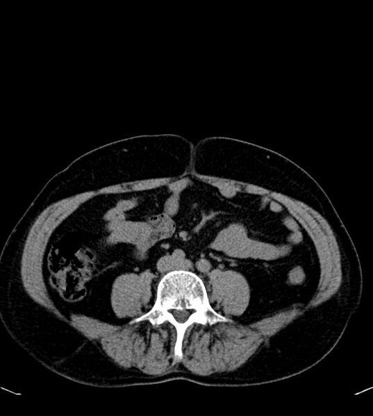 File:Clear cell renal cell carcinoma (Radiopaedia 85006-100539 Axial non-contrast 54).jpg