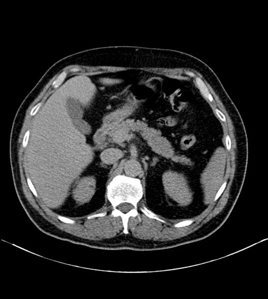 File:Clear cell renal cell carcinoma (Radiopaedia 85006-100539 H 7).jpg