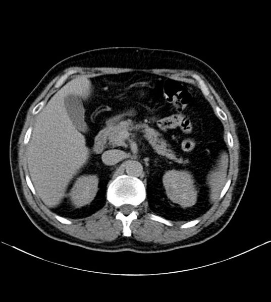 File:Clear cell renal cell carcinoma (Radiopaedia 85006-100539 H 8).jpg