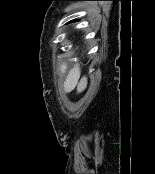 File:Closed-loop small bowel obstruction-internal hernia (Radiopaedia 78439-91096 C 20).jpg