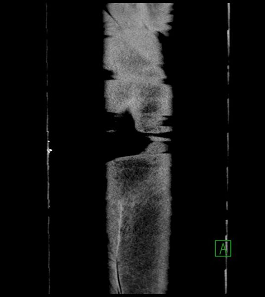 File:Closed-loop small bowel obstruction-internal hernia (Radiopaedia 78439-91096 Coronal non-contrast 108).jpg