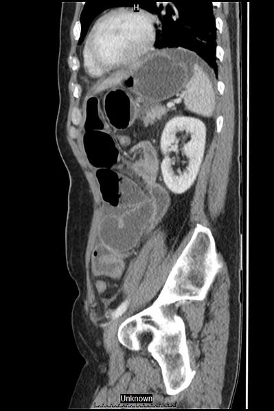 File:Closed loop bowel obstruction and ischemia (Radiopaedia 86959-103180 C 16).jpg