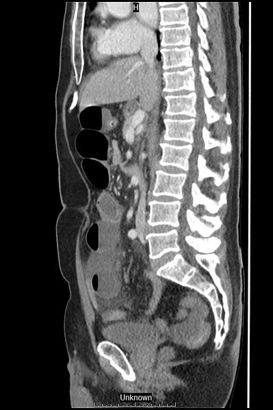 File:Closed loop bowel obstruction and ischemia (Radiopaedia 86959-103180 C 34).jpg