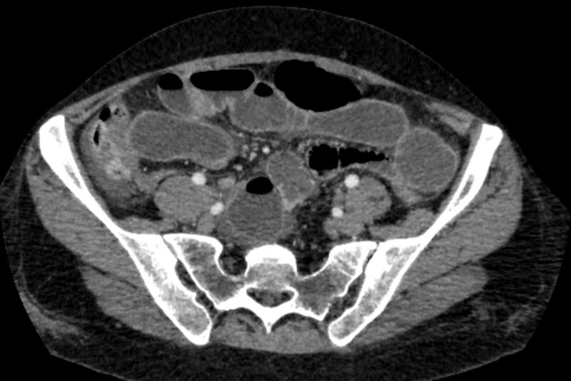 File:Closed loop small bowel obstruction (Radiopaedia 71211-81508 A 110).jpg