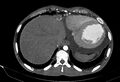 Coarctation of aorta with aortic valve stenosis (Radiopaedia 70463-80574 A 200).jpg